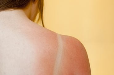 how to hide a sunburn on your wedding day